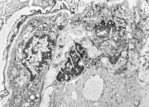 type I membranoproliferative glomerulonephritis